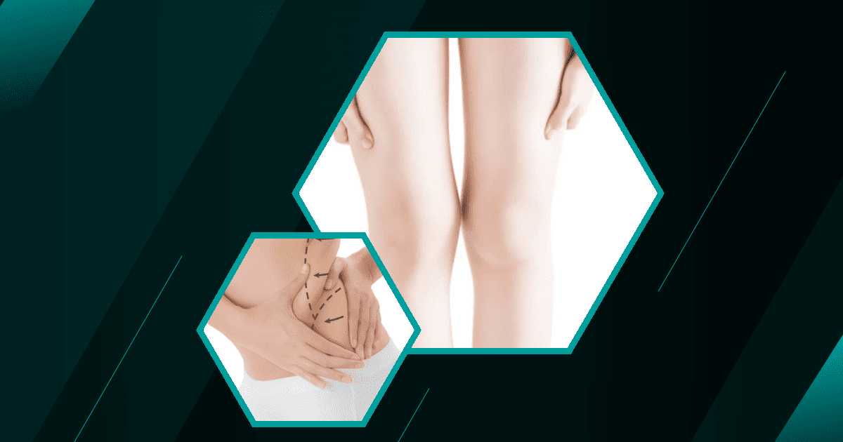 Does-Liposuction-Improve-Health