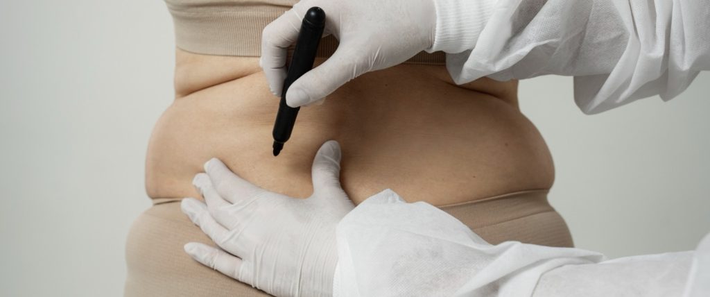 Fat Transfer In Dubai Complete Recovery Guide