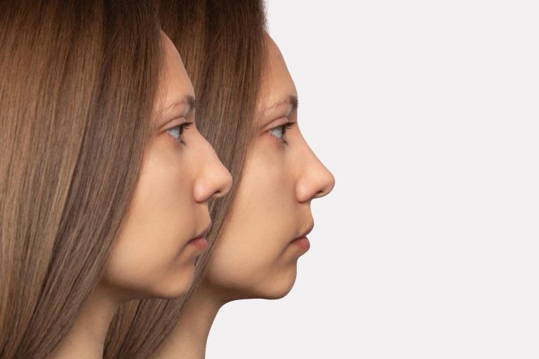 Rhinoplasty In Dubai Aftercare Tips For Smooth Recovery