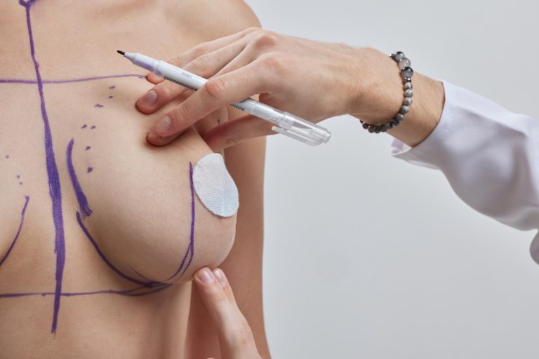 What Happens After Breast Lift In Dubai Recovery &Amp; Aftercare Guide