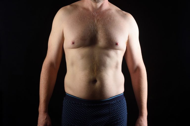 What Happens During Gynecomastia Surgery In Dubai A Step-By-Step Walkthrough