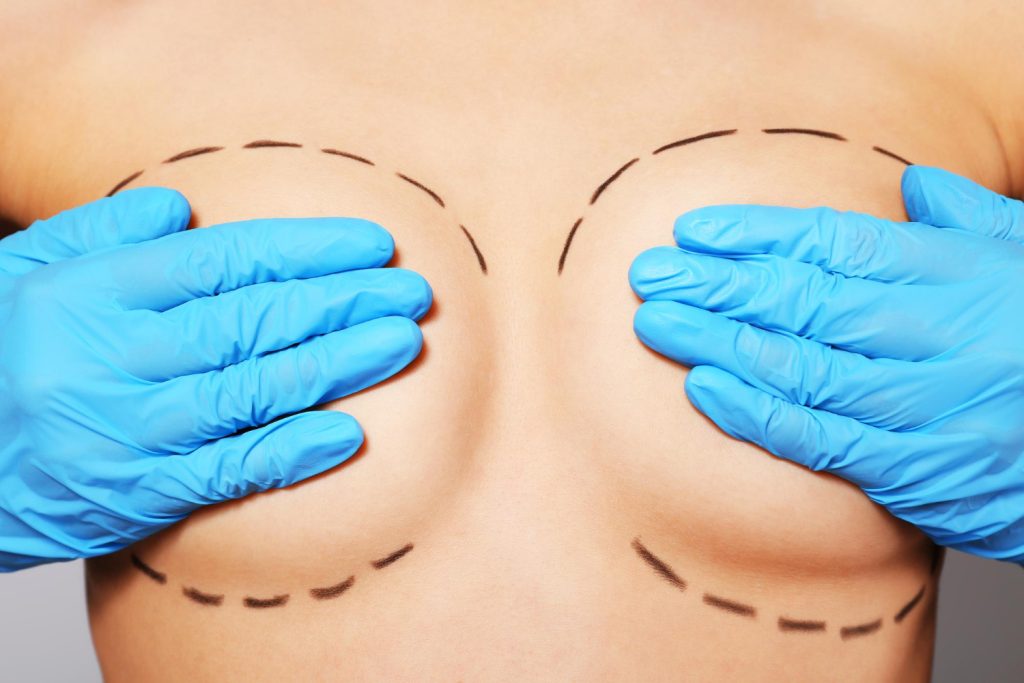 A Complete Guide To Breast Augmentation In Dubai