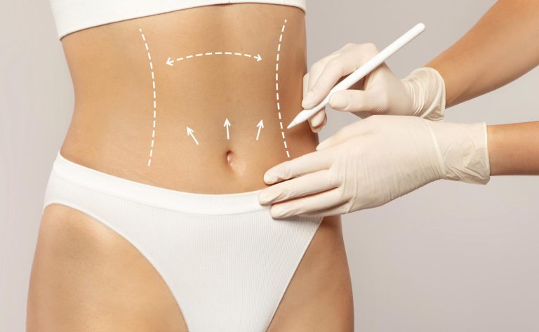 Liposuction And High-Definition Liposuction What’s The Difference