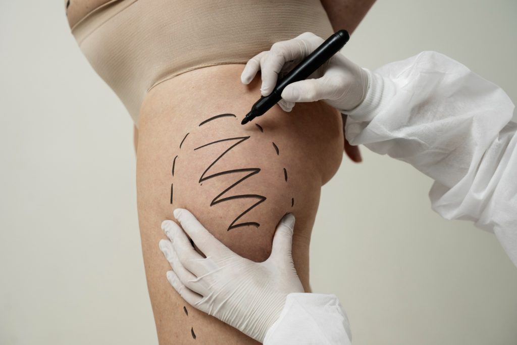 Your Comprehensive Guide to Achieving Thinner Thighs with Liposuction