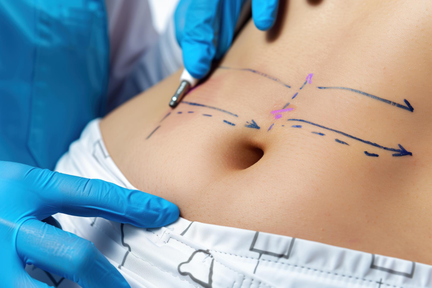 Liposuction Preparation Tips Liposuction Do’s &Amp; Don’ts