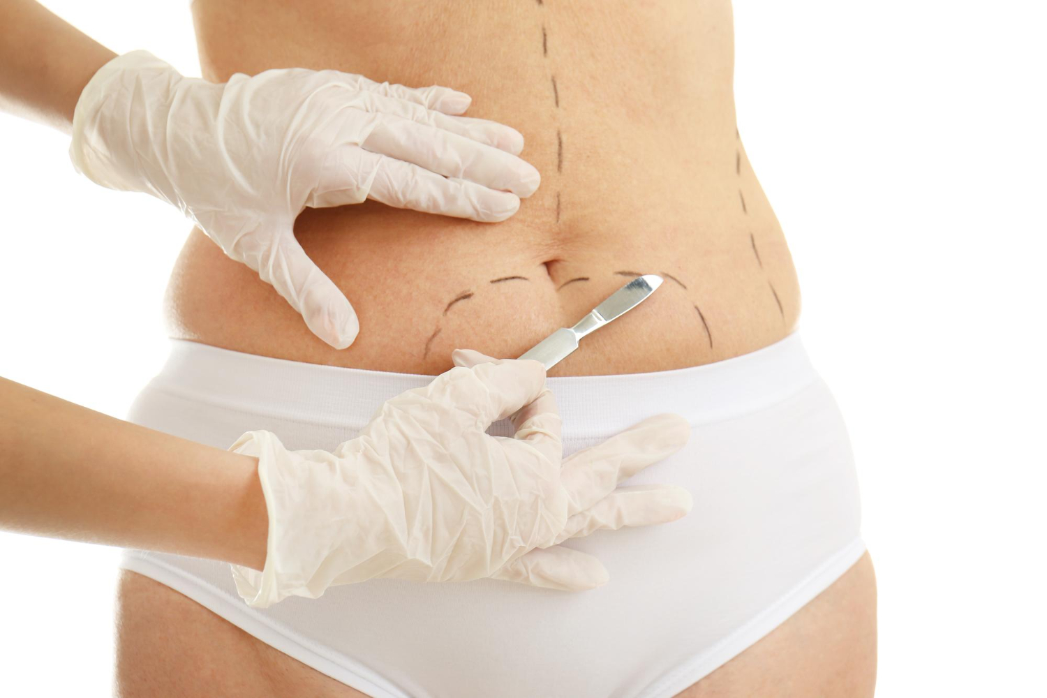 Your Guide To Tummy Tuck Surgery